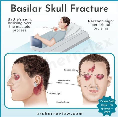 Basal skull fracture and the halo sign